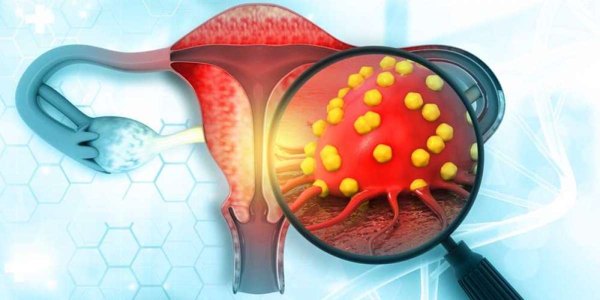 Hormone Therapy For Ovarian Cancer Patients
