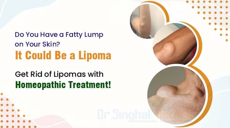 Get Lipoma Treatment in Homeopathy with Sustained Results