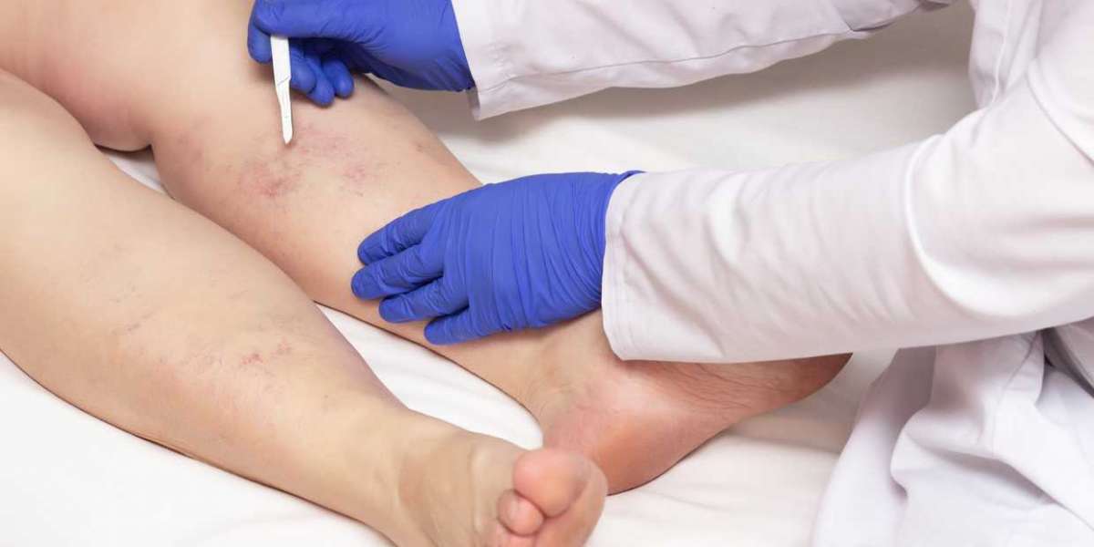 Understanding Varicose Veins: Non-Surgical Options and When to Seek Help