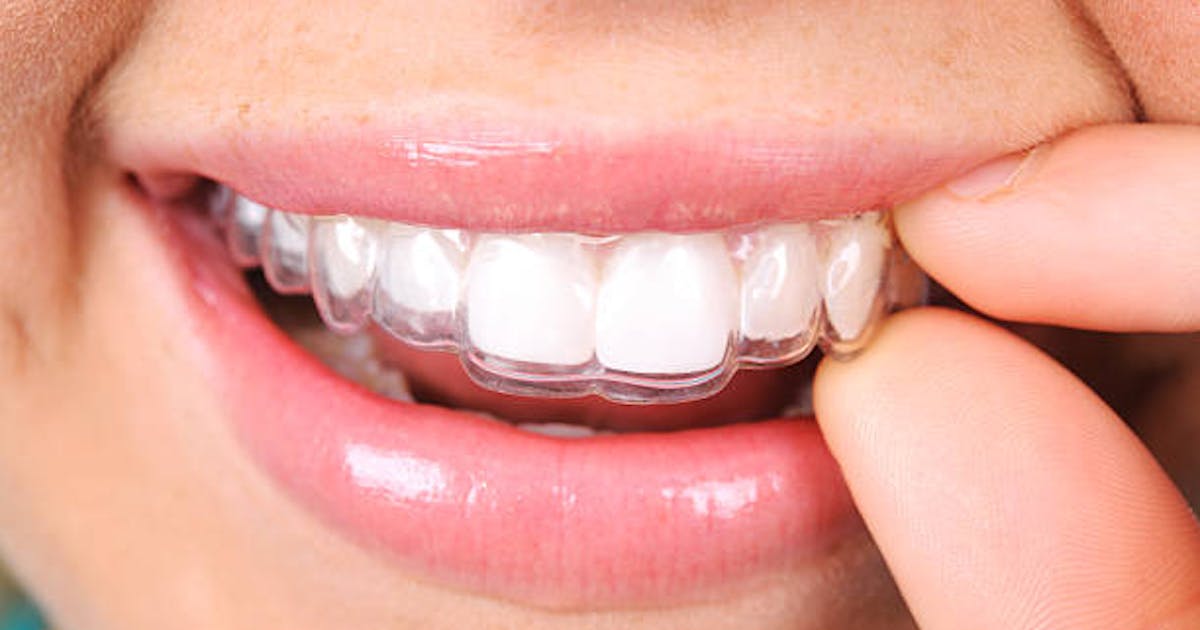 Invisalign is the Solution for Various Orthodontic Concerns