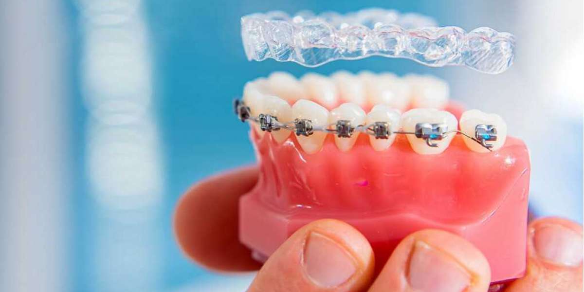 Invisalign in Florham Park: A Clear Path to Your Best Smile