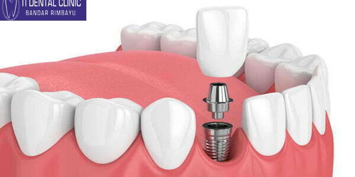 Dental Implants: Transforming Smiles and Lives at Tidental