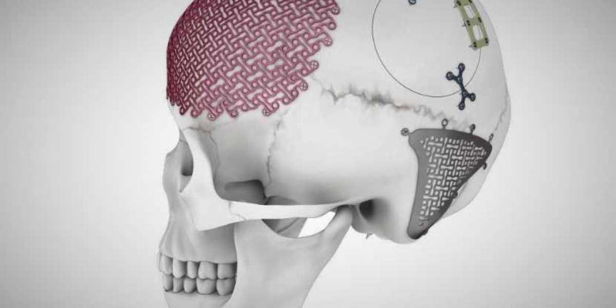 Global Craniomaxillofacial Implants Market: Growth Projections and Key Drivers (2024-2032)