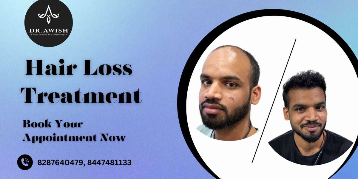 Best Hair Loss Solutions for Men Regain Your Confidence