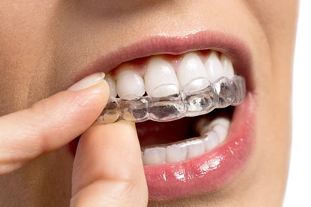 5 Reasons why you should choose Invisalign for a perfect smile