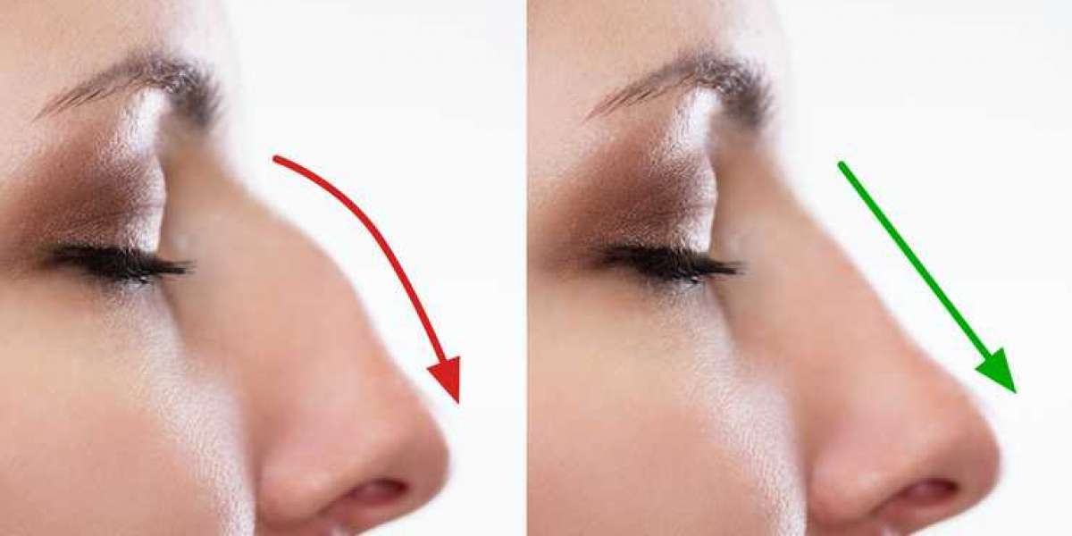 Best Rhinoplasty Surgeon in Lahore: Expertise & Affordable Rhinoplasty Cost in Lahore