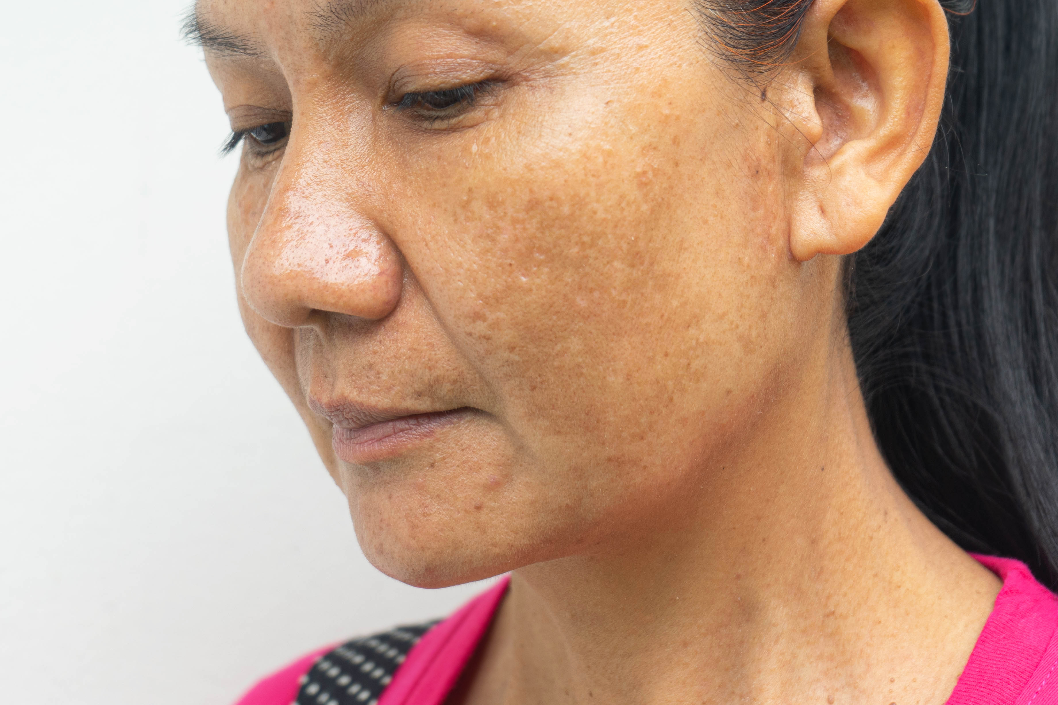 Laser Treatment for Melasma on Face | Gilded Leaf Med Spa