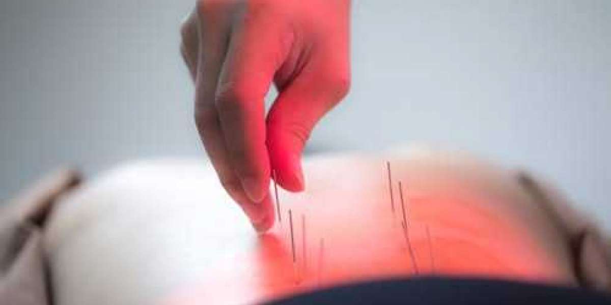 Relieve Pain Naturally with Acupuncture for Pain in Morristown – CM Harmony USA