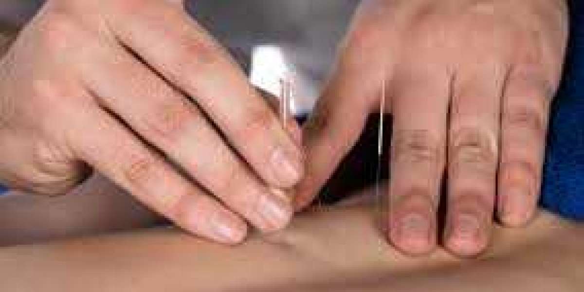 Discover the Benefits of Dry Needling Treatment Near You in Abbotsford