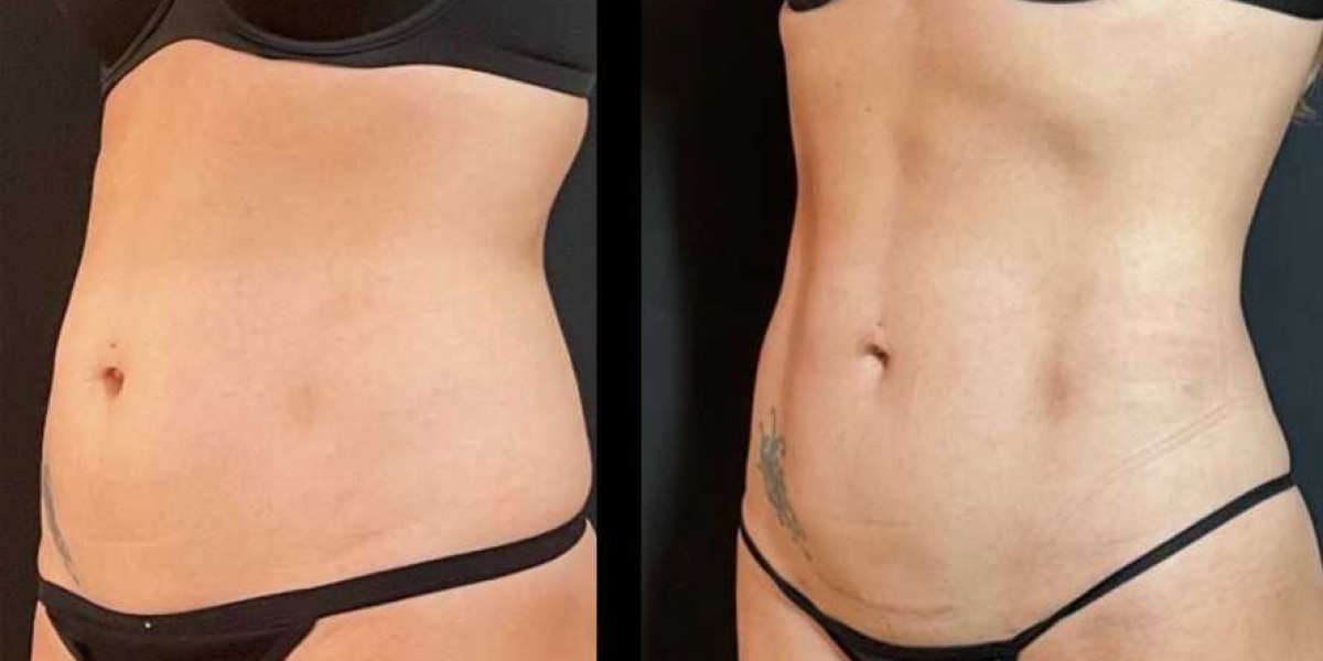 Everything You Need to Know About Liposuction in Tucson, AZ