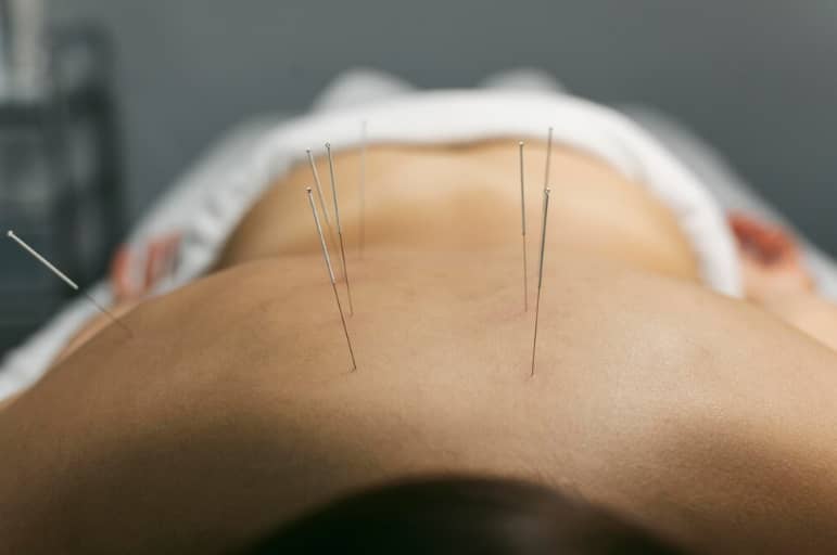 How Long Acupuncture Needles Stay In? Duration & Benefits