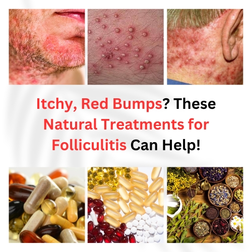 Itchy, Red Bumps? These Natural Treatments for Folliculitis Can Help! - Natural Health News