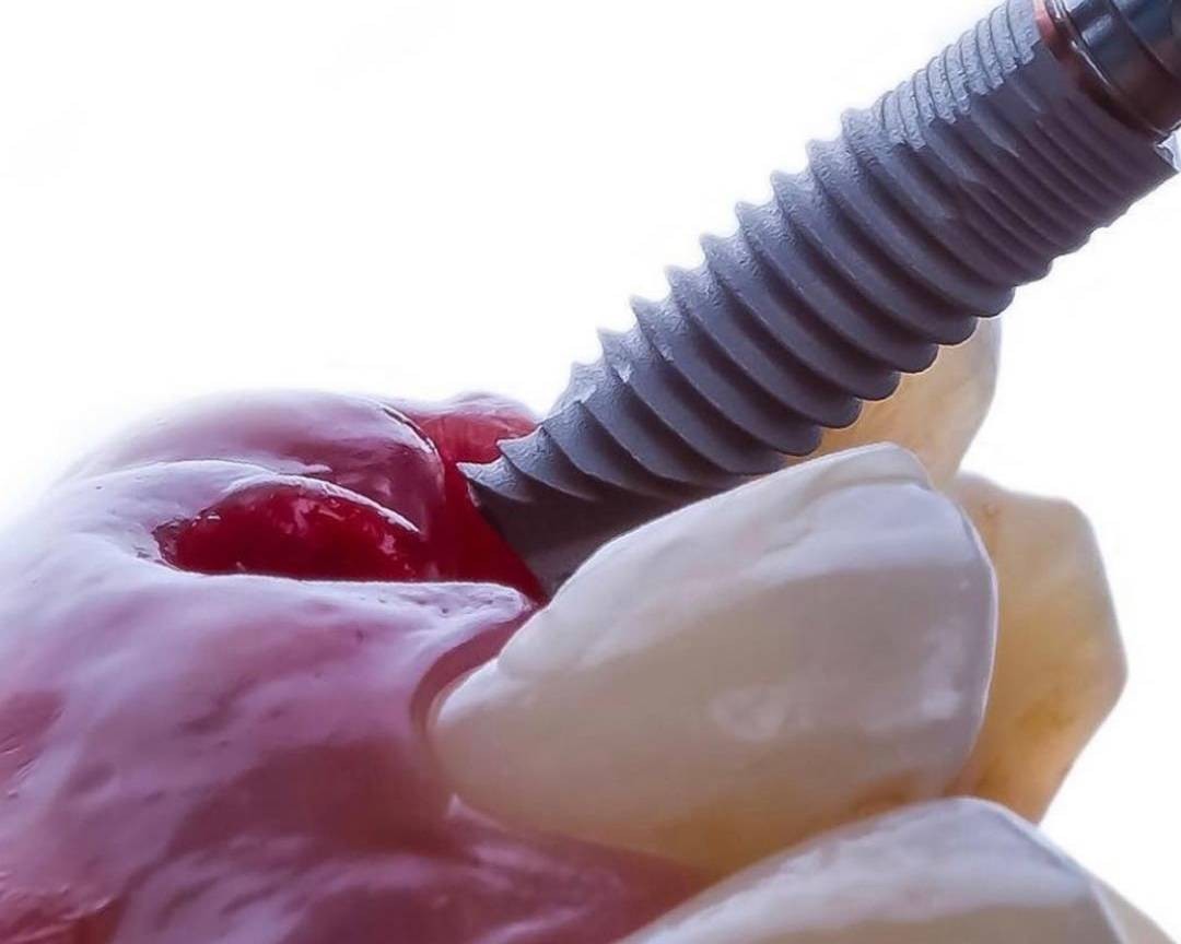 Root Canal Treatment: An Ultimate Tooth-Saving Solution | Buzzy