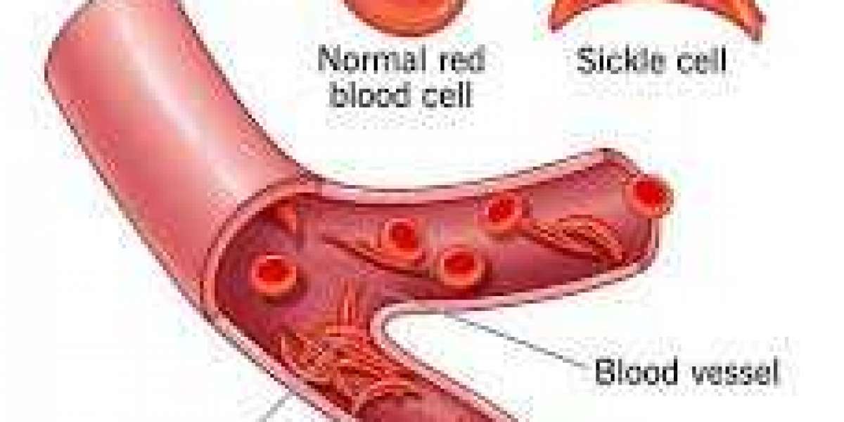 Understanding Cell Anemia: Causes, Symptoms, and Treatment