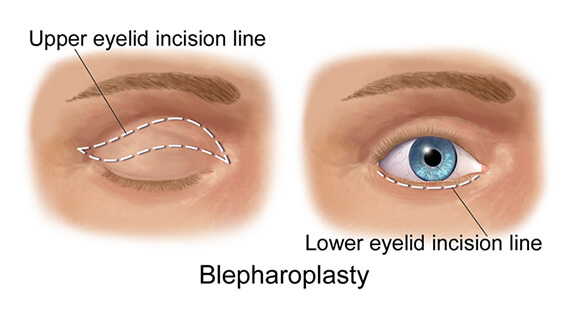 Blepharoplasty - Eyelid Surgery & Cost in Delhi India - Dr Rajat Gupta