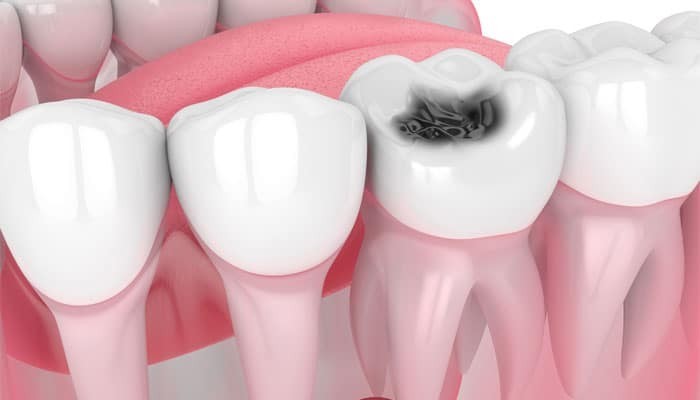 What Parents Should Know About Cavity Treatment for Kids | Buzzy