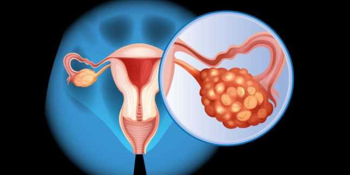 Ovarian Cancer Market Size, Share, Trends | Industry Forecast 2025-2033