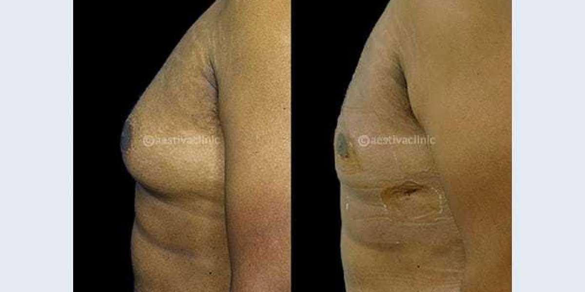 Understanding Gynecomastia Surgery Cost in India and the Rise of Aestiva as a Trusted Treatment Center