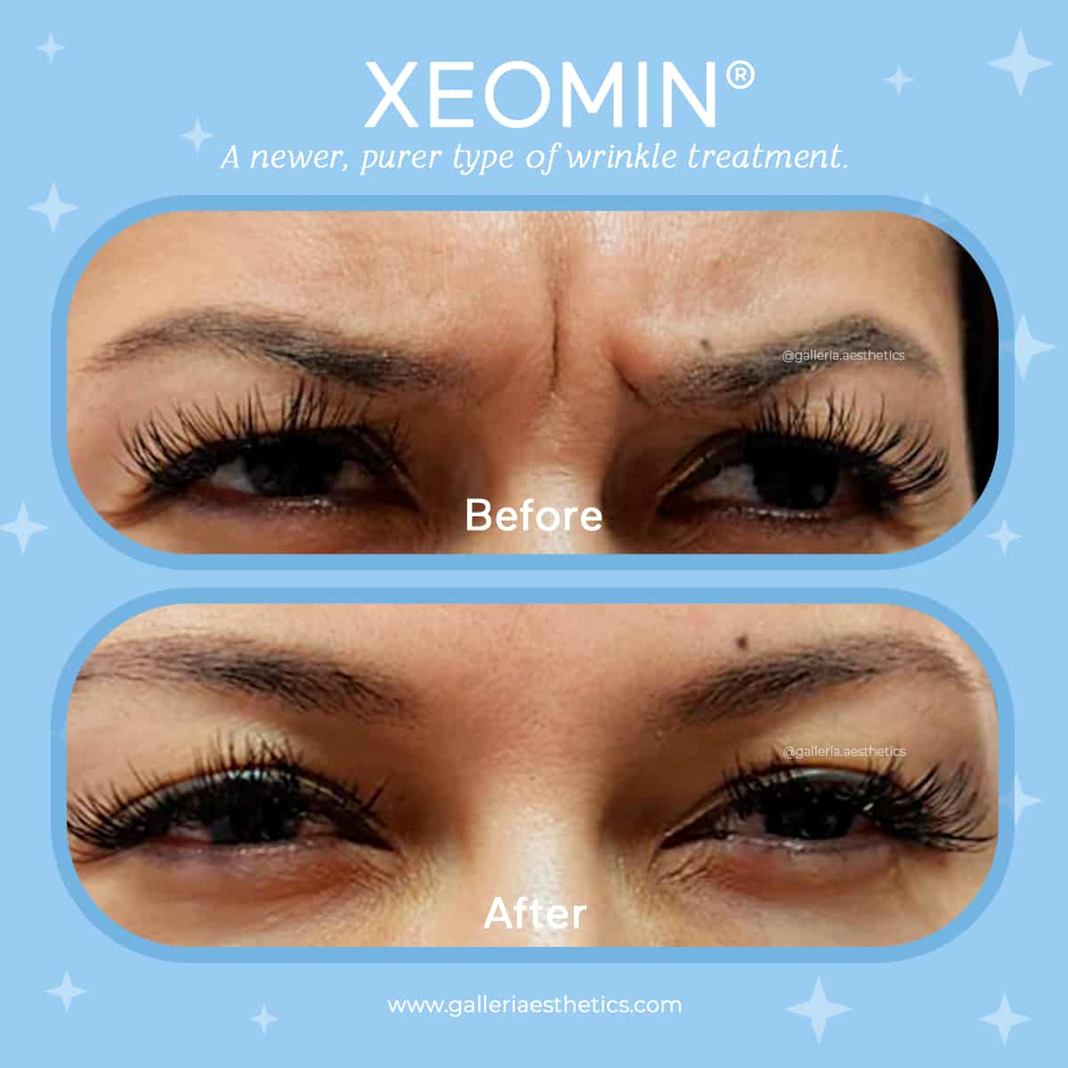 Anti-Wrinkle Injections Near Houston | Galleria Aesthetics