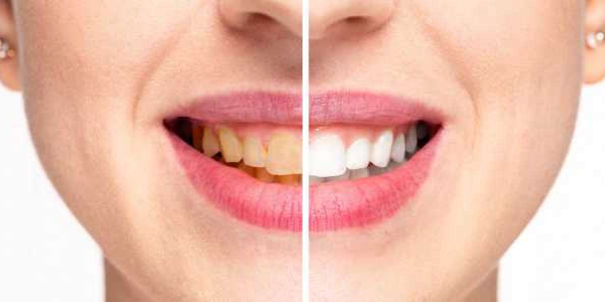 Brighten Your Smile With Expert Teeth Whitening in West Hollywood