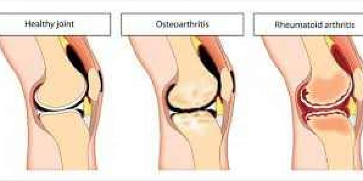 Understanding Osteoarthritis (OA) and Rheumatoid Arthritis (RA): Key Differences and Insights