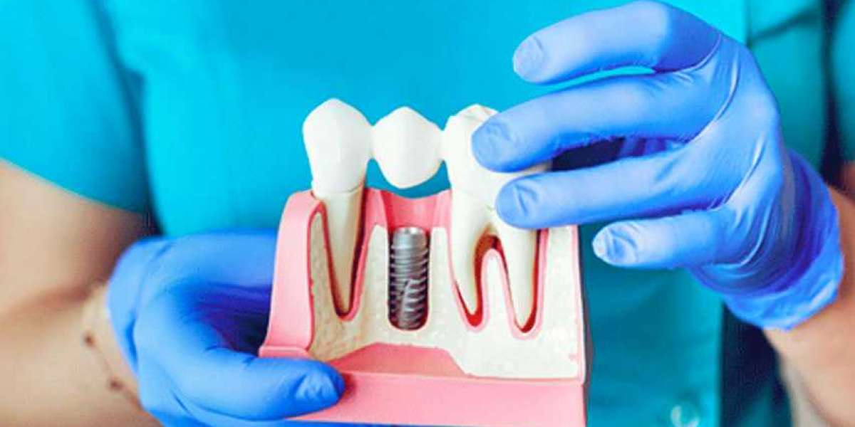 Tampa’s Trusted Solution for Missing Teeth: Dental Implants That Last