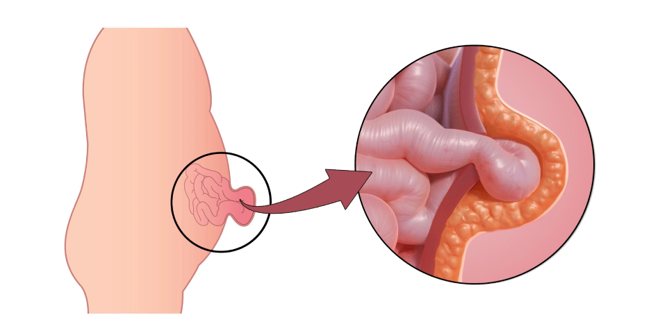 Umbilical Hernia Treatment in Chennai | Dr Pinak Dasgupta