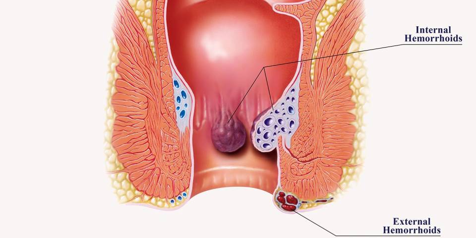Best Piles Specialist in bangalore- Dr. Bhushan Chittawadagi