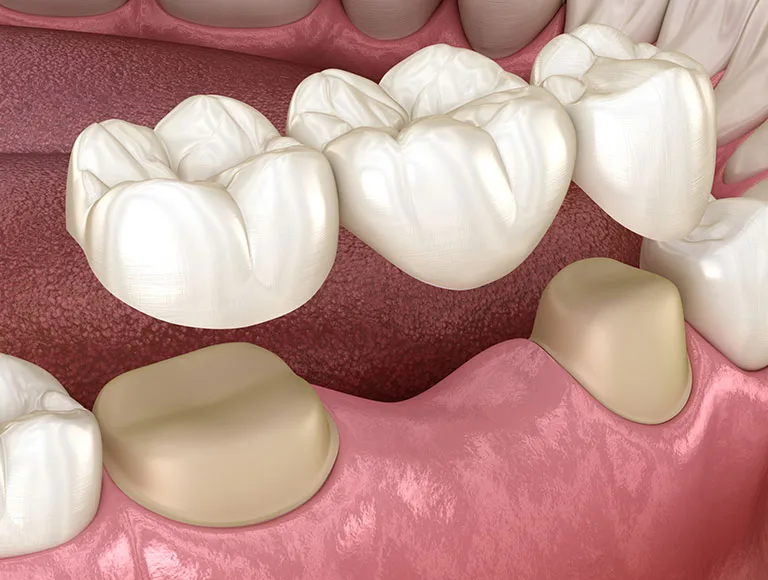 Dental Bridge vs. Implant: Which Is Right for You? – BDnews55.com