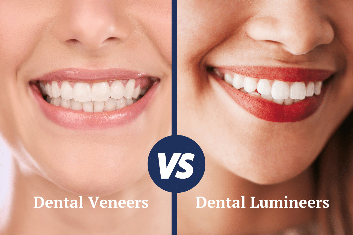 Lumineers vs Veneers; 10 Keys Differences You Should Know