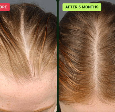 Halo Grow Hair Spray® UK ✴️ save up to -46% SHOP | HaloGrow™