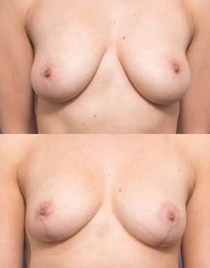 Breast Reduction Surgeon in Brisbane | Mammaplasty Reduction